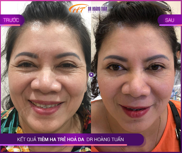 Kết quả tiêm HA trẻ hoá da tại Thẩm mỹ Hoàng Tuấn